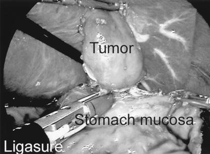 knifeinsertedintothesubmucosal layer.then,threequartersofthemarkedwascut circumferentialyusingtheit knifeinthe00-w ENDO-CUT mode.