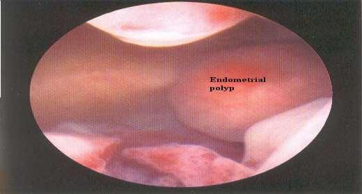 endometrija endometrijski karcinom