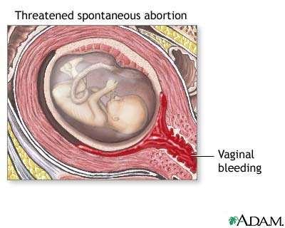 nepopolni splav zunajmaternična nosečnost molarna nosečnost