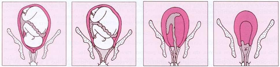 PORODNE DOBE 1. maternično ustje dozori in se odpre (več ur, popadki redni, proti koncu boleči) 2.