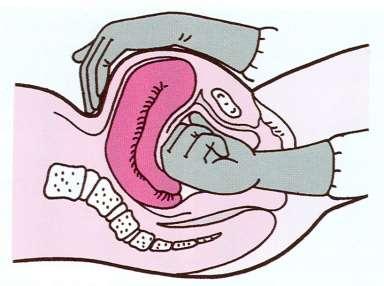 POPUŠČANJE MATERNICE (ATONIJA) Klinična slika: močna krvavitev iz rodil po ločitvi posteljice, maternica na otip mehka Opozorilo: Smrtno nevaren zaplet po porodu, pri katerem porodnica izkrvavi v
