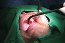 Ak sa však pacient o implantát nestará napríklad pacient so zlou hygienou by vôbec nemal byť indikovaný, teda nemal by vôbec dostať implantát okolo implantátu vznikne zápal, kosť sa začne rezorbovať