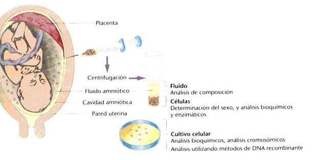 Screening pre-natal Técnica de amniocentese, para detectar