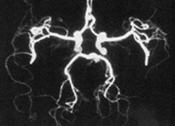 Cerebral Angiography