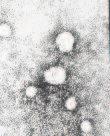 Prognostički testovi Hepatitis D (delta) virus (HDV) antigen HBsAg GENOTIPIZACIJA genotipovi 1 i 4 imaju lošiju prognozu i slabo reagiraju na terapiju METODE: Određivanje genotipa sekvencioniranje