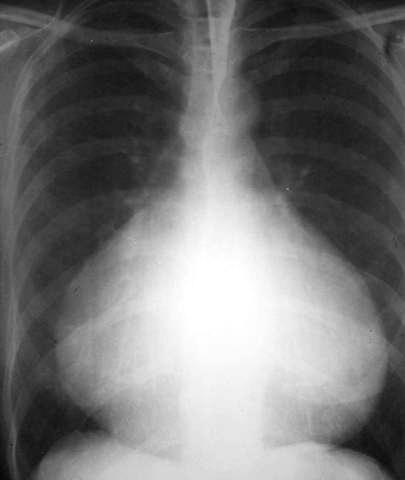 Pericardial effusion