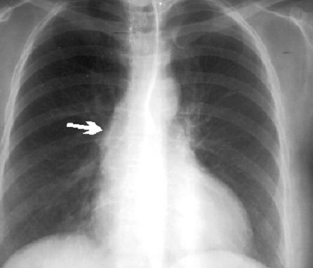 Ascendentna aorta HTA Ao.stenoza Ao.