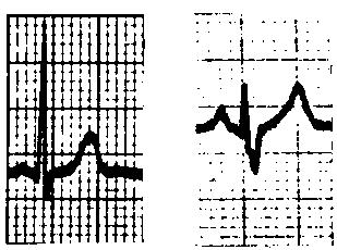 10 Osnove elektrokardiografije Spoznali bomo lastnosti električnega dipola in se seznanili z opisom srca kot električnega dipola.