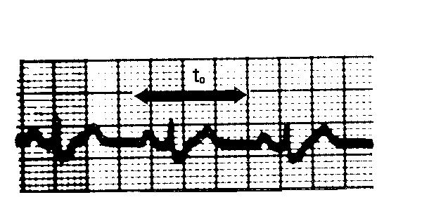 I II III Slika 10.7: Elektrokardiogram (bipolarmi standardni odvodi I, II in III) je ponavljajoča se funkcija s periodo delovanja srca t 0.