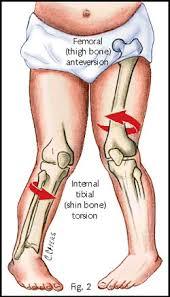 Εσωτερική Στροφή Ακρων Ποδών (Femoral torsion-in toeing) άνω πέρας του μηριαίου, εκτός της αυχενομηριαίας γωνίας, παρουσιάζει & πρόσθια στροφή & κλίση (anteversion) Οταν το παιδί αρχίζει να βαδίζει,