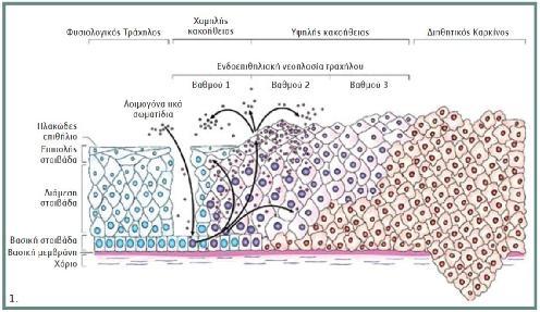Εικόνα 6: Η εξέλιξη του διηθητικού καρκινώματος του τραχήλου της μήτρας. Πηγή:https://www.hygeia.gr/moriakoi-mixanismoi-karkinomatodoys-eksallagis-ystera-apo-loimoksime-io-anthropinoy-thilomatos/ 4.