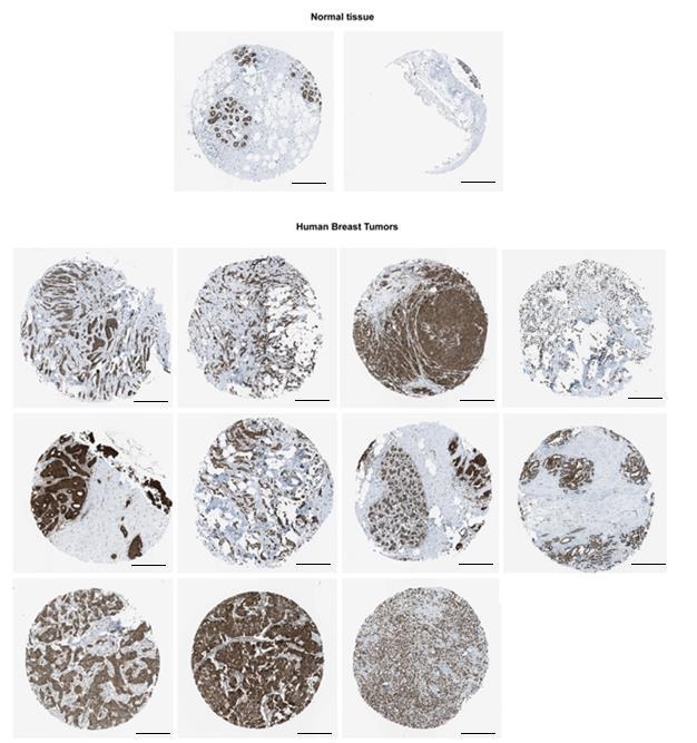 Fig. S2. CK1δ is overexpressed in human breast cancer specimens.
