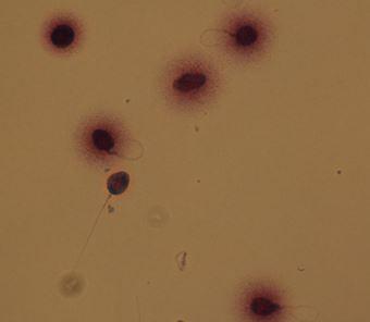 Analiza DNK fragmentacije u spermijima Halosperm test SPERMIJI BEZ DNK FRAGMENTACIJE spemiji s velikom aurom: širina aure jednaka ili veća od manjeg promjera jezgre spermiji sa srednjom aurom: