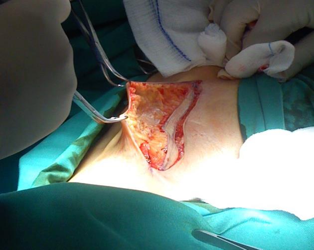 Περιγραφή χειρουργικής τεχνικής Ο ασθενής τοποθετείται με το κάτω άκρο σε θέση ελαφριάς κάμψης και έξω στροφής. Διενεργείται καμπυλόγραμμη τομή S που ξεκινά 2-3 εκ.