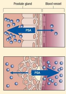 Παθοφυσιολογία του PSA Το PSA βρίσκεται φυσιολογικά στο αίμα αλλά σε πολύ μικρές ποσότητες.