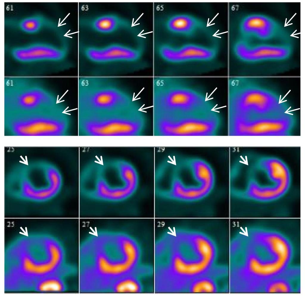 FDG positron emission tomography (PET).