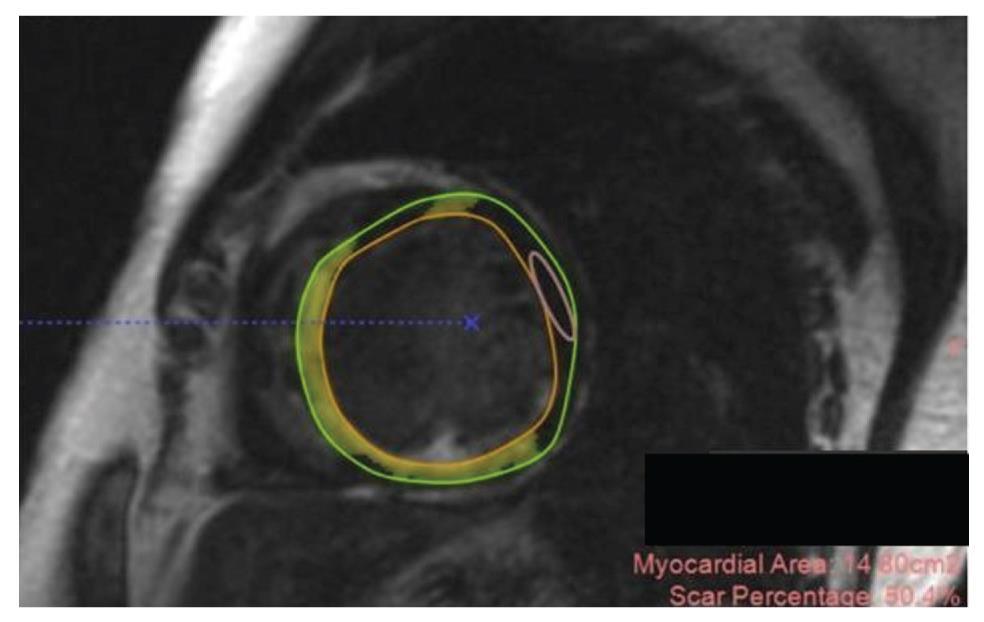 CMR Scar burden analysis using short-axis delayed