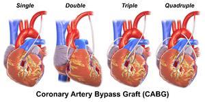 5 STEMI & CABG