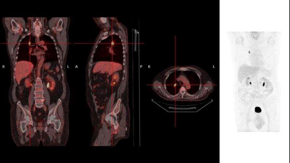 PET/CT