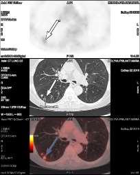 Ασθενής πρόσληψη της 18 F FDG (SUV max:3,3) σε πνευμονικό όζο