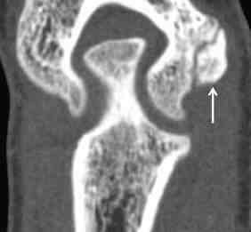 Overuse injuries of the upper extremity in the competitive athlete: Curr Probl Diagn