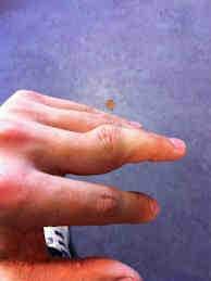 injury, and ulnar variance in the young