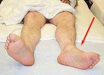 (2003) Pelvic and hip apophyseal avulsion