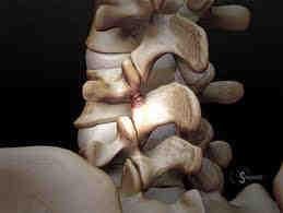 Lumbar spondylolysis in children and adolescents.
