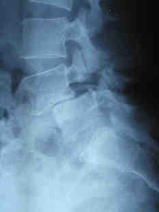 Libson et al Symptomatic and Asymptomatic Spondylolysis and Spondylolisthesis in Young