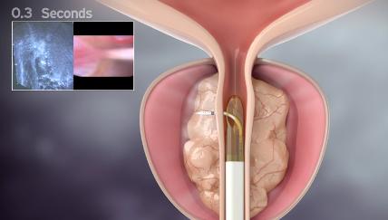 Βολή ατµού στην Υπερπλασία προστάτη Θεραπεία που γίνεται στο ιατρείο FDA approved: 2015