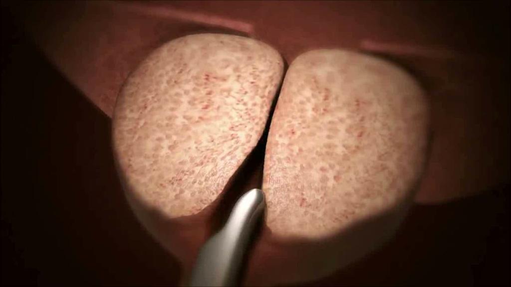 UroLift (NeoTract Inc.