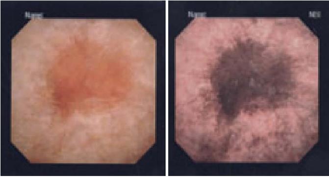 Narrow-band imaging (NBI) Φιλτράρει το λευκό φως σε δύο μήκη κύματος (μπλε στα 415 nm και πράσινο στα