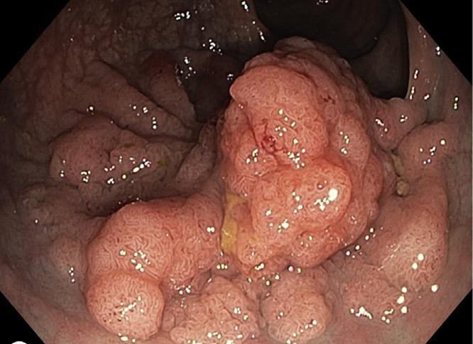 Lateral spreading tumors Κοκκιωματώδης Μικτός
