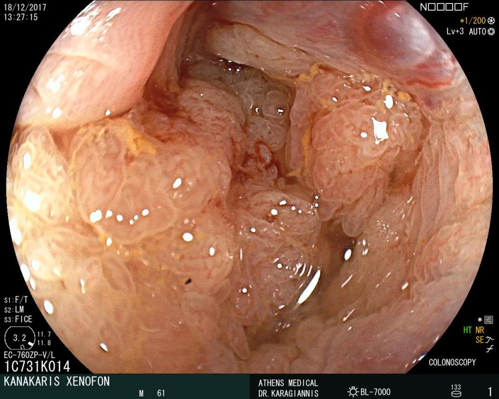 Lateral spreading tumors Δεν περιλαμβάνονται στην ταξινόμηση Παρισίων Κοκκιωματώδης όψη ESGE recommends that for flat and sessile (Paris II and Is) polyps 10 mm, termed laterally spreading lesions