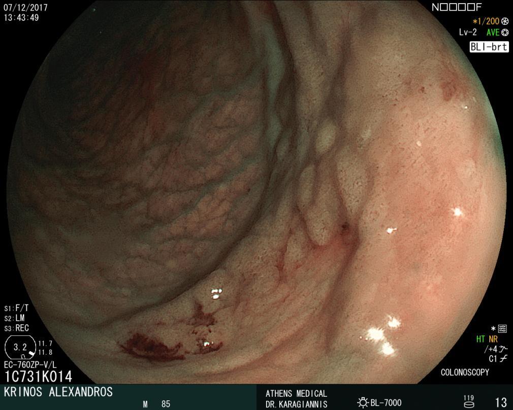 ) When advanced imaging is not available, standard chromoendoscopy may