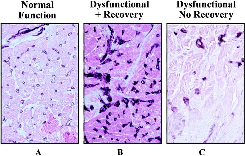 MCE-Hibernating myocardium MCE δείκτες και αναγνώριση ληθαργικού μυοκαρδίου