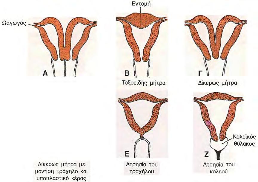 στη λιγότερο σοβαρή μορφή της η μήτρα παρουσιάζει ελαφρά εντομή στο μέσον του πυθμένα της (καρδιόμορφη ή τοξοειδής μήτρα). Μια από τις πλέον κοινές ανωμαλίες είναι η δίκερως μήτρα.