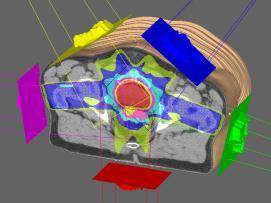 ΑΚΤΙΝΟΘΕΡΑΠΕΙΑ 3D CRT IMRT TOMOTHERAPY