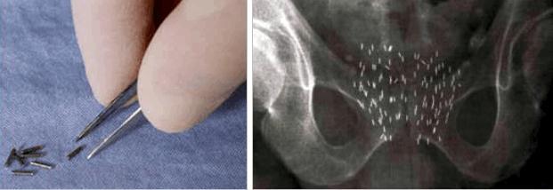 ΒΡΑΧΥΘΕΡΑΠΕΙΑ Low risk 5year 10 year RFS 71-93% 65-85% Complications Urinary retention 1.