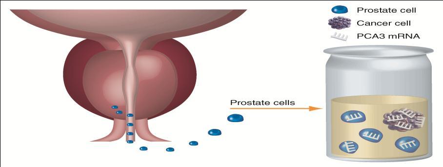 PCA3 Progensa test Το γονίδιο PCA3 έχει βρεθεί ότι υπερεκφράζεται στα προστατικά καρκινικά κύτταρα.