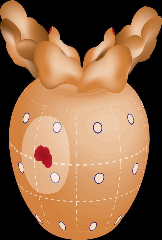 Το ConfirmMDx detects a field effect or halo associated with the presence of cancer at the DNA level.