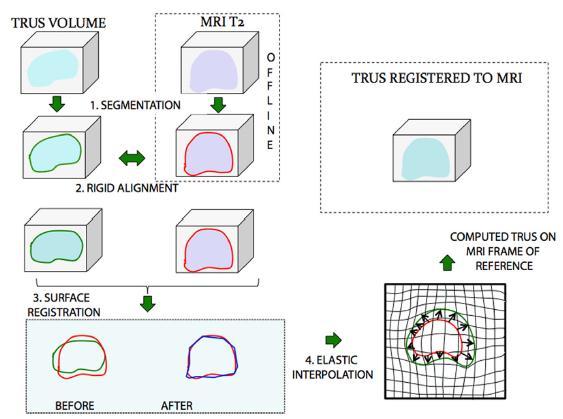 MR TRUS fusion Με μια συσκευή σύνθεσης εικόνων (fusion) οι αποθηκευμένες εικόνες MRI μαζί με