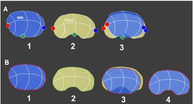 Rigid registration vs. elastic registration A Elastic Three deformation points have been with placed surface-based on the MRI registration (1) and TRUS and prostate organ deformation. contour (2).