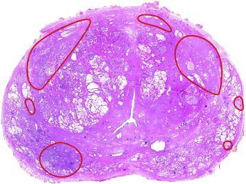 Μοριακά κριτήρια εισαγωγής ασθενών σε AS Oncotype DX Prolaris