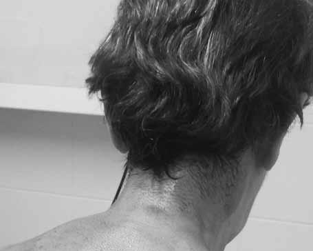24 Αρβανίτη Χ., Μπατιστάκη Χ. Eικόνα 1. Eικόνα 3. Eικόνα 2. ινιακού νεύρου ο ασθενής θα πρέπει να είναι καθισμένος με την κεφαλή και τον αυχένα σε ουδέτερη θέση ή σε ελαφρά κάμψη [1,3].