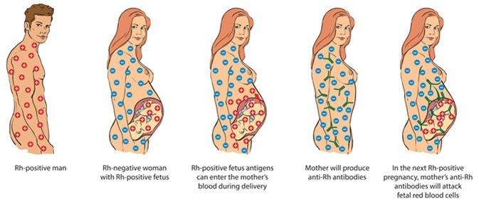 ΑΙΜΟΛΥΤΙΚΗ ΝΟΣΟΣ ΝΕΟΓΝΟΥ (ΑΝΝ) Μικρές ποσότητες αίματος διαρρέουν από την εμβρυική στην μητρική κυκλοφορία της μητέρας κατά τον τοκετό Πατέρας RH + Μητέρα Rh- Έμβρυο Rh+ Η μητέρα παράγει αντι- RHESUS