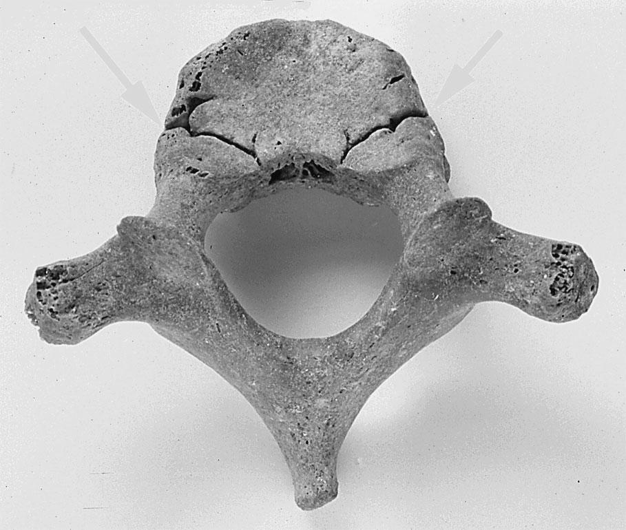 The three ossification centers, which appeared in the fetus, are synchondrosis at birth.