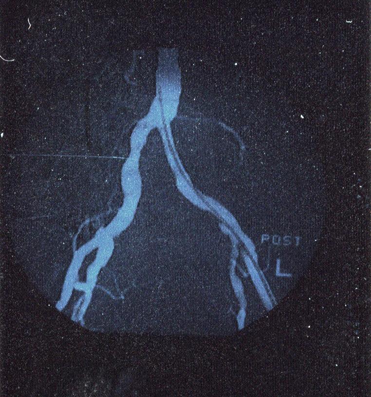 stent