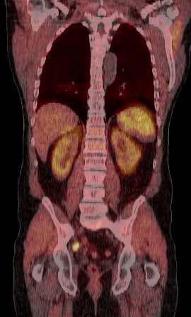 O ασθενής υποβάλλεται σε 11-choline PET/CT