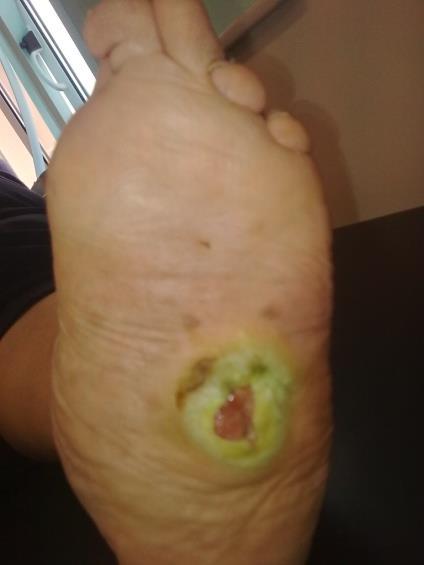 Diabet Foot Ankle 2013